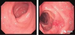 萎縮性胃炎不可怕，只要