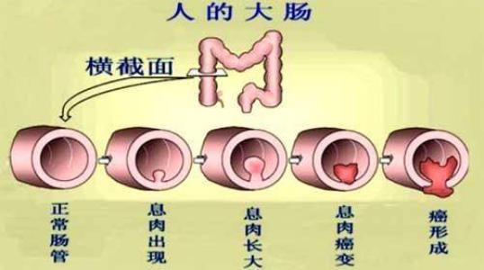 南寧治療結(jié)腸炎要多少費(fèi)用