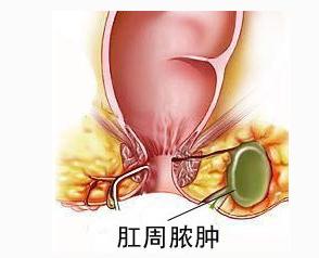 南寧哪個(gè)醫(yī)院治療肛周膿腫好