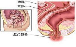 南寧治療脫肛哪家醫(yī)院好？南寧脫肛治療多少錢(qián)？